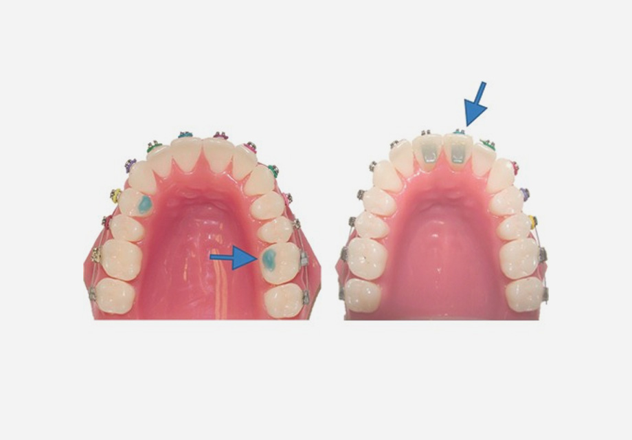 Bite Bumps
