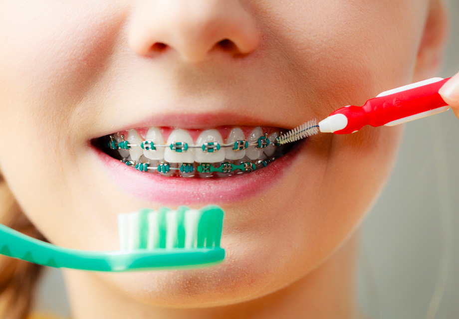 Brushing With Braces
