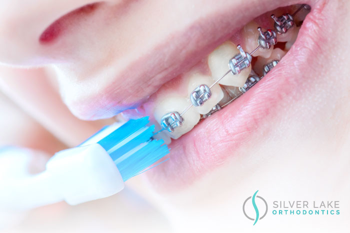Brush Your Teeth With Braces