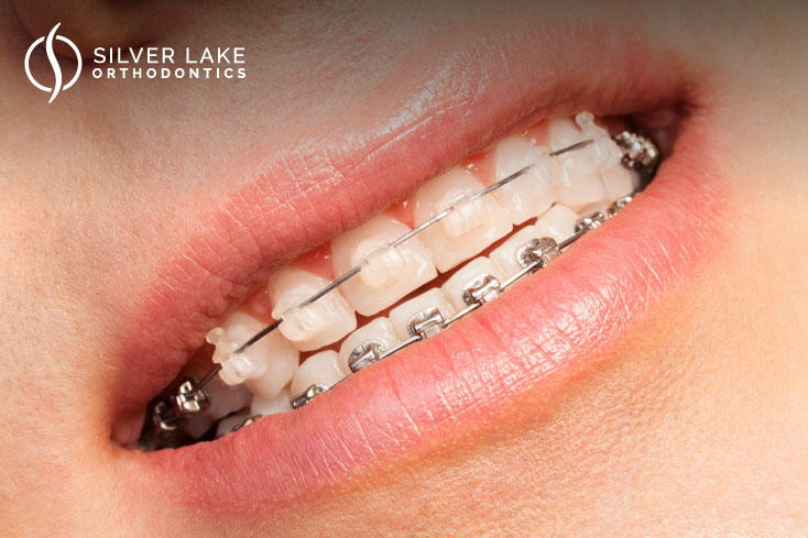 Exploring Various Orthodontic treatment Topics