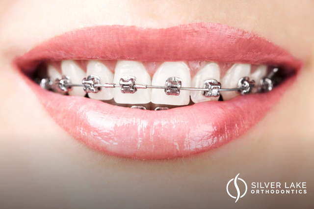 Clear Braces Or Invisalign